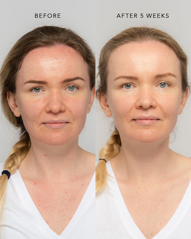 redness spots routine results